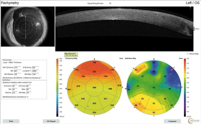 Figure 3. OCT spectral domain de l’œil gauche. L’épithélium, la membrane basale, le stroma et le complexe endothélio-descémétique du greffon ont un aspect normal 19 ans après la greffe. On note néanmoins une variabilité de l’épaisseur épithéliale, fréquente après une greffe.
