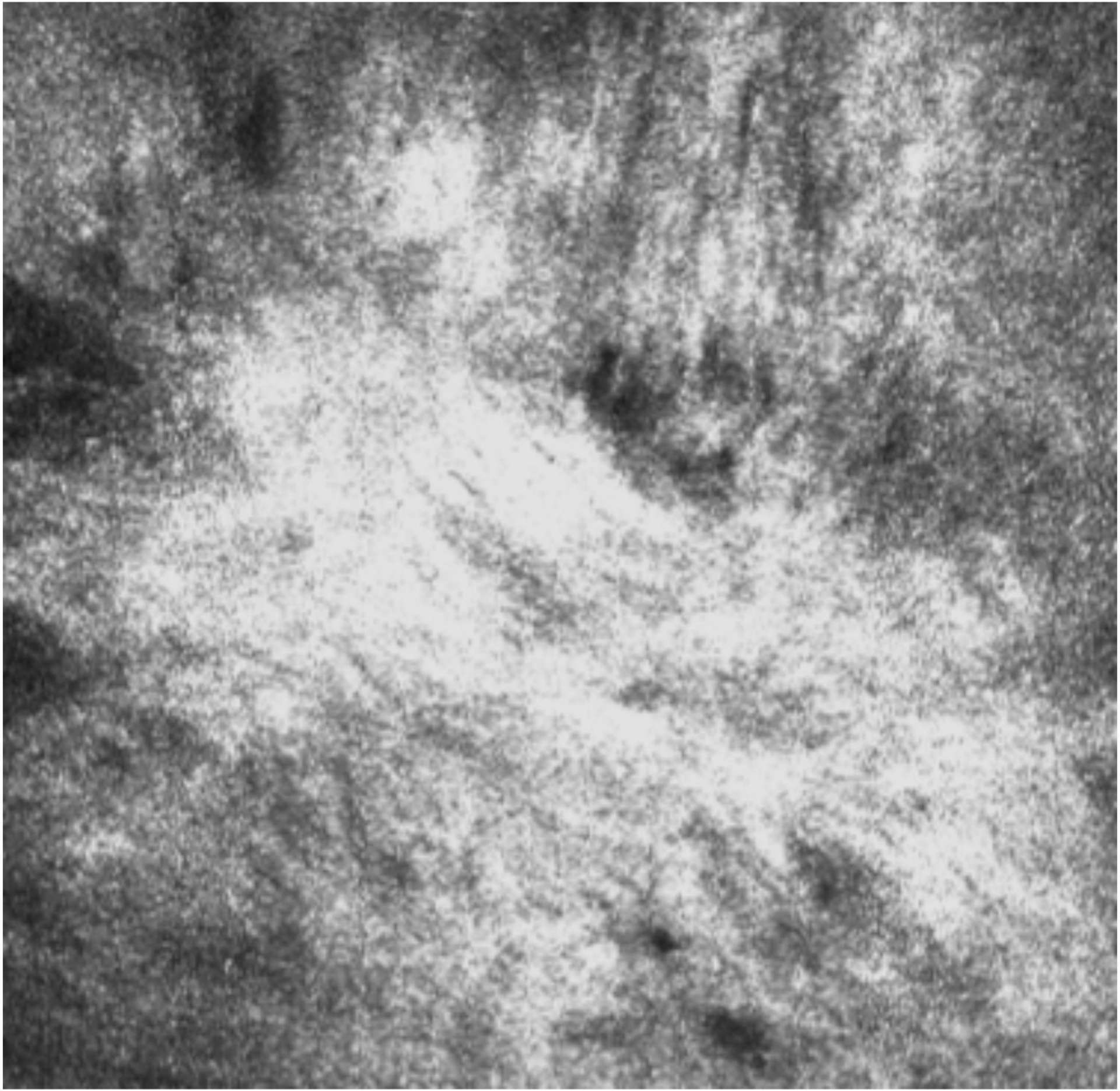Figure 4. Microscopie confocale in vivo d’un patient présentant un déficit en cellules souches limbiques. ­Visualisation d’une ­fibrose sous-épithéliale.
