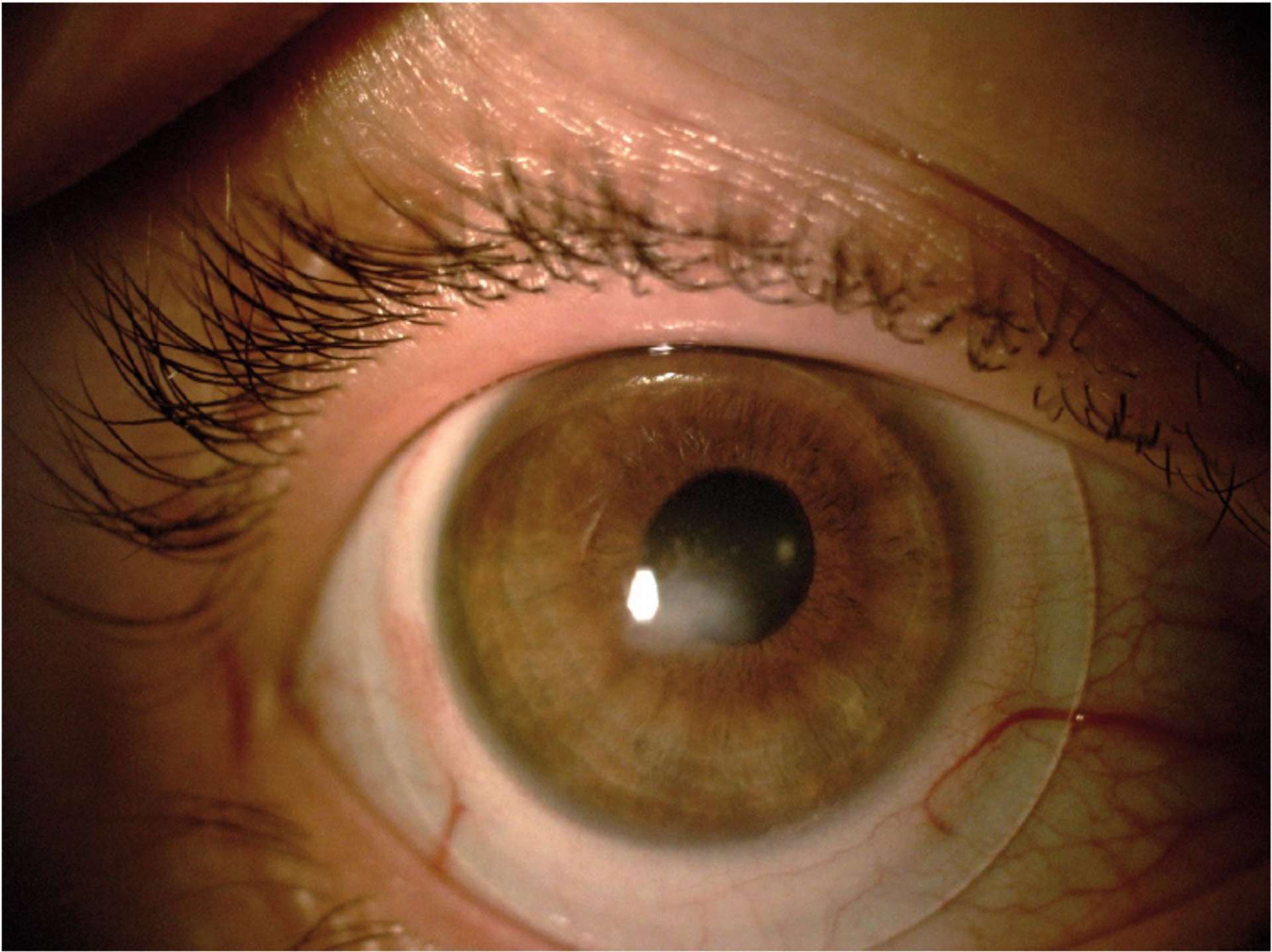 Patiente de 30 ans présentant une dystrophie nodulaire de Salzmann équipée avec des lentilles sclérales.

