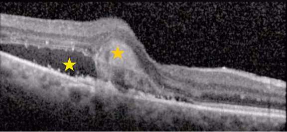 Figure 2. Coupe d’OCT B-scan montrant un néovaisseau choroïdien de type 1 avec présence d’un décollement séreux rétinien (étoile jaune) et d’un matériel hyperréflectif sous-rétinien (SHRM « subretinal hyperreflective material ») (étoile orange).&nbsp;
