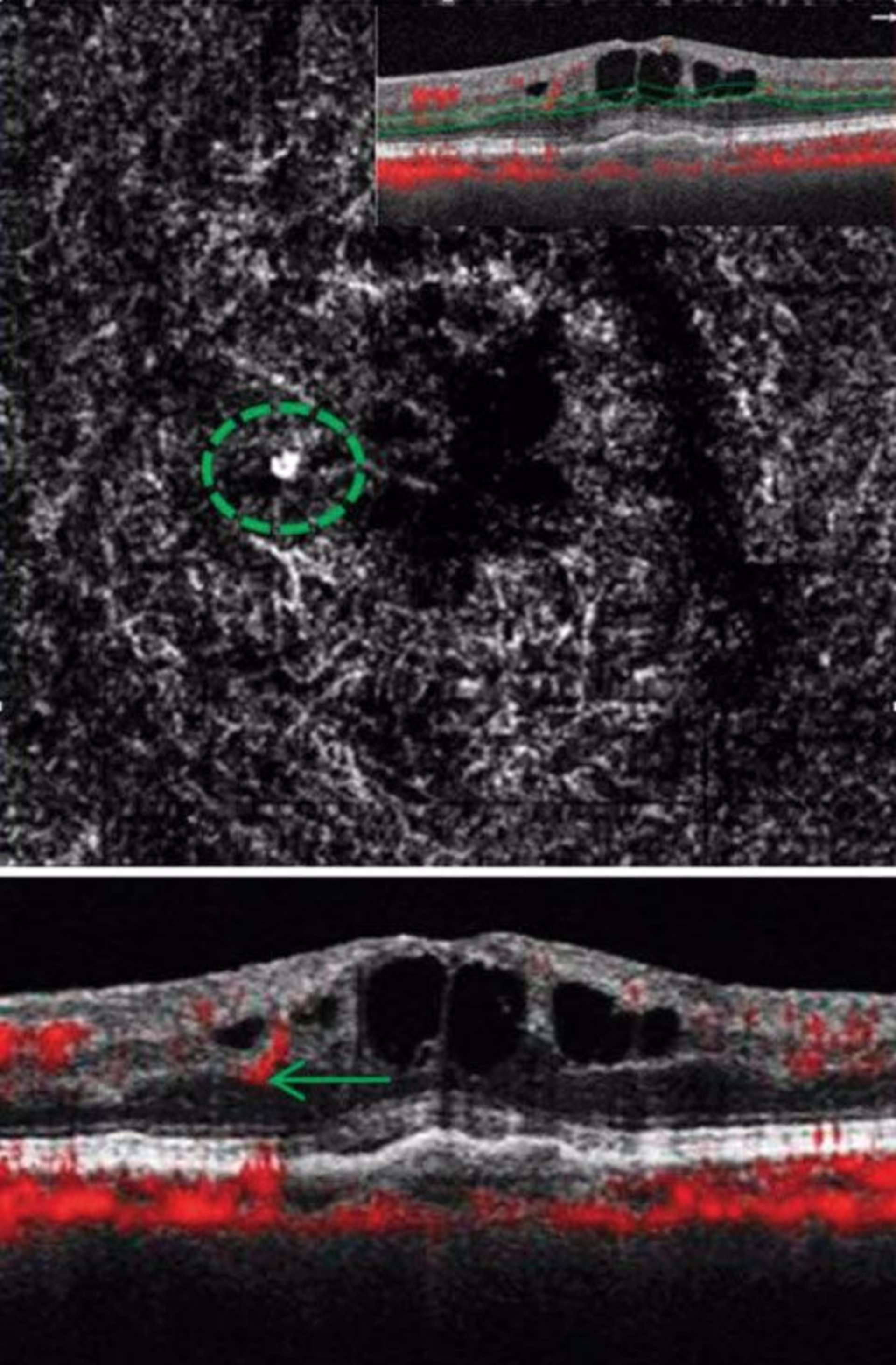 La lésion apparaît comme une touffe vasculaire à flux élevé sur l’angiogramme (cercle vert). La segmentation utilisée est visible sur l’OCT B-scan en haut à droite (ligne verte). L’OCT B-scan avec signal de flux (points rouges) en bas, montre que le flux au sein de la lésion est intrarétinien et provient du plexus capillaire profond (flèche verte)

