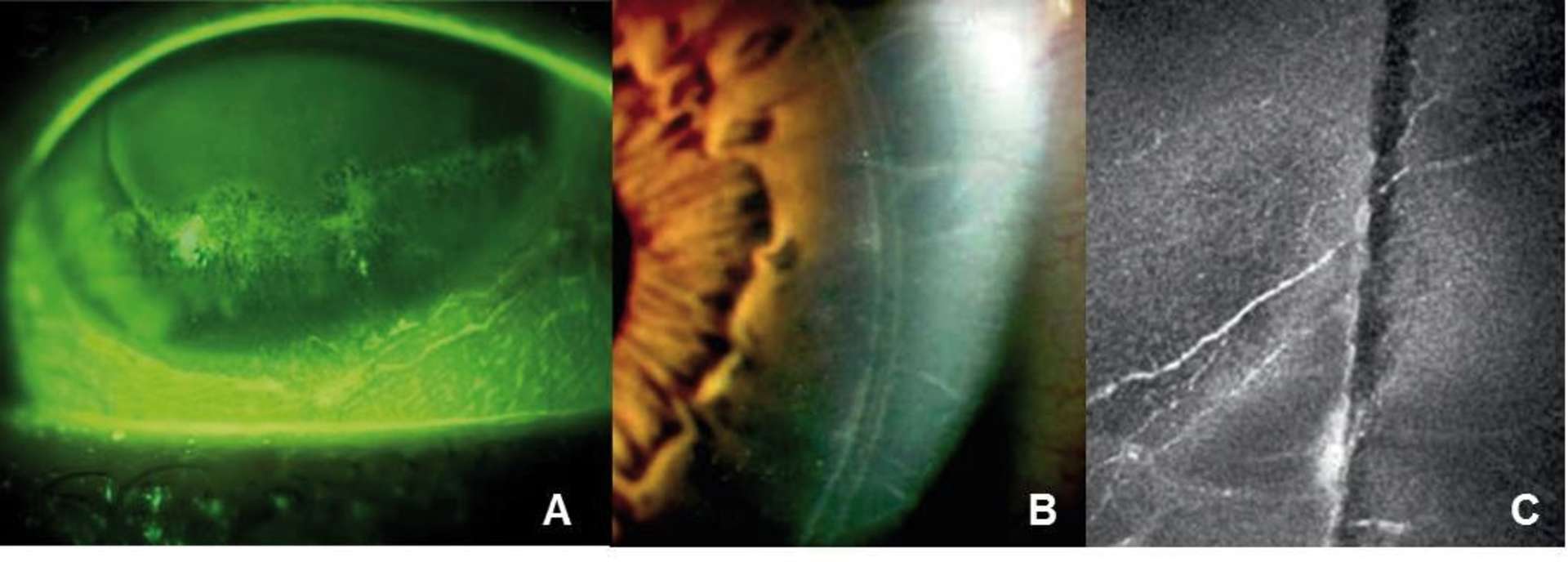 Figure 3. Sécheresse oculaire sévère après une chirurgie réfractive par procédure LASIK, kératite ponctuée sévère bien visualisée après ­l’instillation de fluorescéine (A) ; les rebords du capot sont bien ­visibles à l’examen biomicroscopique (B), mais également en microscopie confocale in vivo, objectivant la ­section nerveuse et la diminution de la densité du plexus sous-basal (C).
