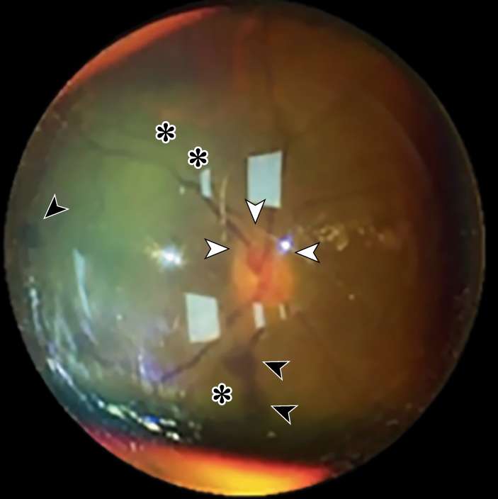 A Man in His Early 50s After 9 Sessions of 18-Hour Prone-Position Ventilation -&nbsp;Left eye&nbsp;
