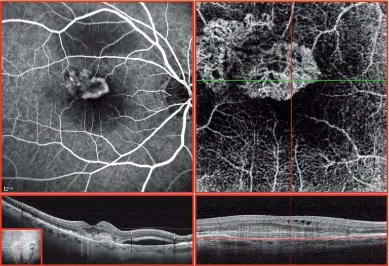 Corrélation entre une angiographie à la fluorescéine et l’angiographie-OCT (cube de 3 x 3 mm) dans un cas de DMLA avec néovascularisation mixte active. L’absence de diffusion en angiographie-OCT nous permet de mieux percevoir la structure néovasculaire avec la composante sous-épithéliale et pré-épithéliale sur le même cliché.
