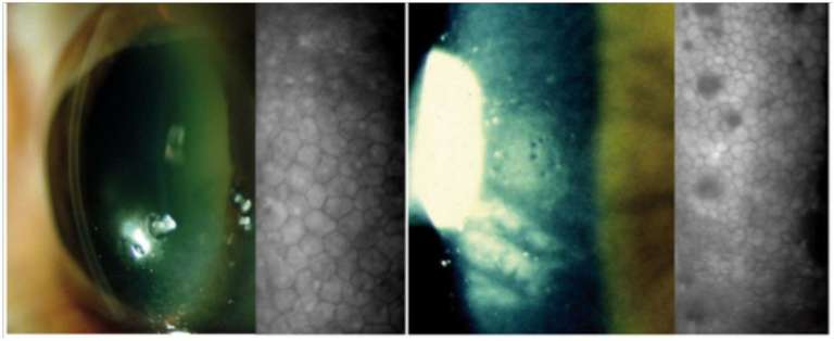 Figure 2. Dégénérescence cellulaire endothéliale liée à l’âge : diminution de la densité cellulaire endothéliale (1 000 cellules/mm2) sans anomalie visible à la lampe à fente (A) ; cornea guttata visible à la lampe à fente au grossissement 40 en conditions de réflexion spéculaire sur l’endothélium et en microscopie spéculaire (B).
