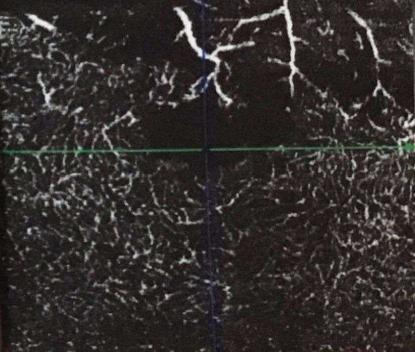 Figure 7. OBVR. B. Plexus capillaire profond : rupture de la maille vasculaire périfovéale, télangiectasies et zones d’ischémie mieux individualisées.
