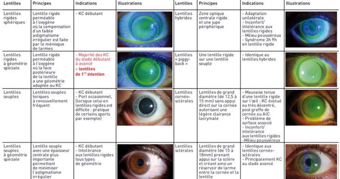Figure 3. Diaporama des lentilles disponibles pour les kératocônes : principes, indications et illustrations.
