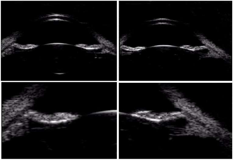 Figure 3. Coupes du segment antérieur en biomicroscopie ultrasonore : apposition de l’iris et de la face antérieure du cristallin (en haut) et dépôts de pigments sur les fibres zonulaires (en bas).
