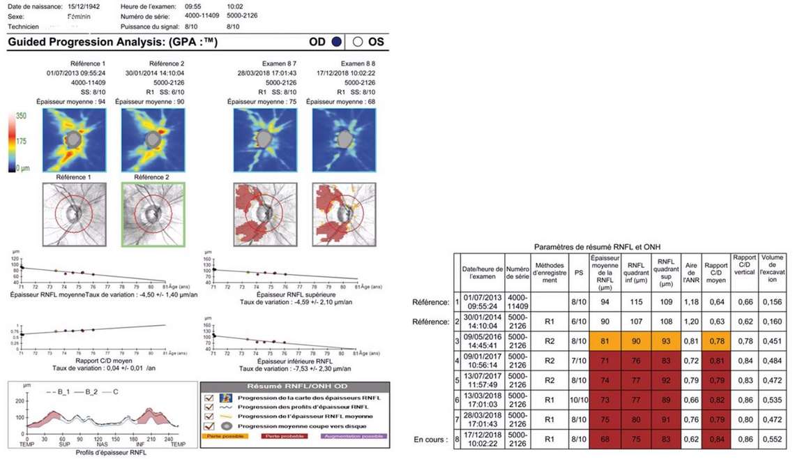 Figure 1. Analyse automatisée d’événements – Cirrus™ HD-OCT Zeiss. Analyse statistique des paramètres par rapport aux valeurs de référence initiale, significative d’une évolution pathologique possible (jaune) puis confirmée probable (ocre).
