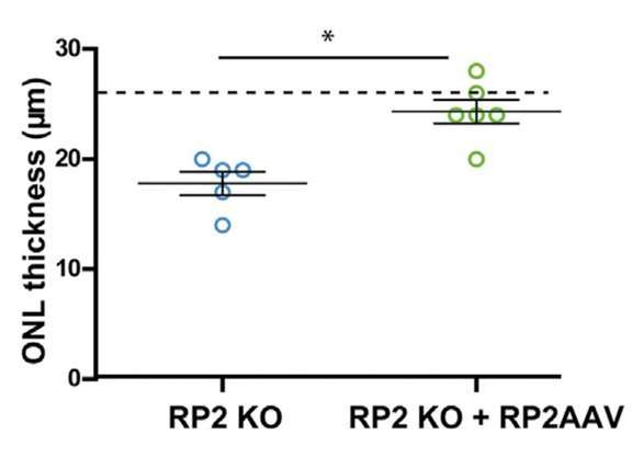 L’immunocytochimie révèle l’expression de la protéine RP2 (en vert) et de la rhodopsine (en rouge) chez les souris modèles pour la mutation du gène RP2 non traitées et chez celles ayant reçu la version fonctionnelle du gène.
