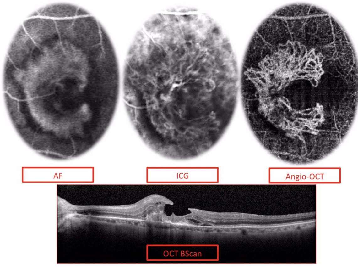 Imagerie multimodale d’un néovaisseau de type 2 associant angiographie à la fluorescéine (AF), angiographie au vert d’indocyanine (ICG), en OCT-A et en OCT B-scan
