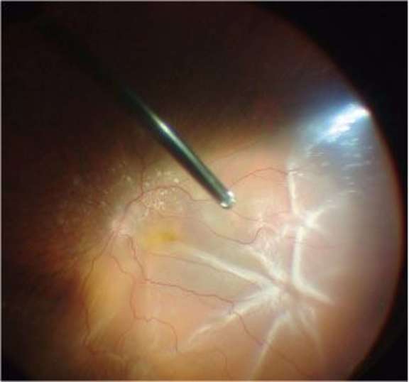 PVR stade C focale postérieure (type 1) : nœud étoilé
