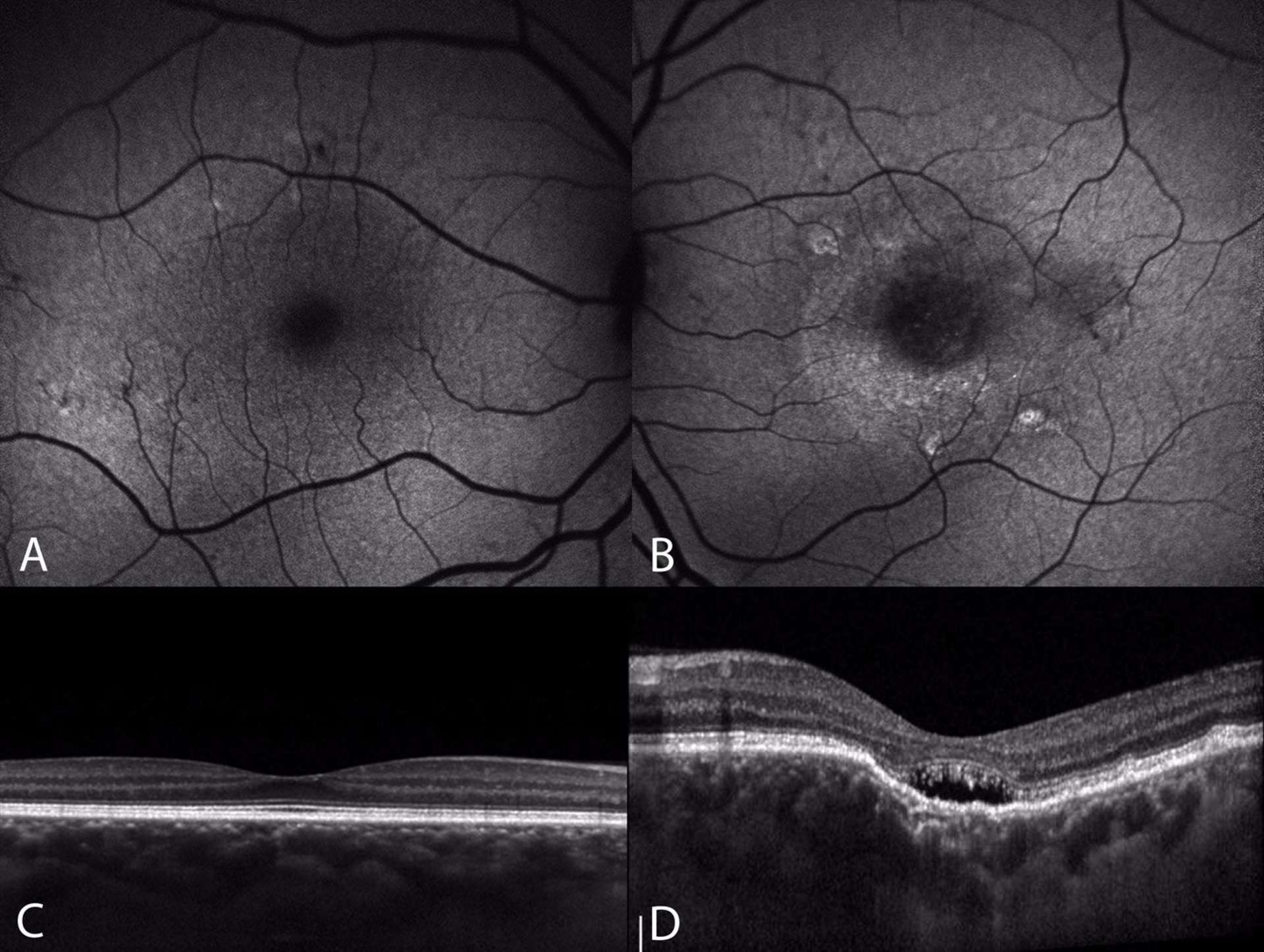 Figure 3. Clichés en autofluorescence (A, B) et OCT en mode EDI (C, D) d’une patiente de 55 ans avec une excavation choroïdienne focale fovéolaire au niveau de l’œil gauche. Au niveau de l’œil droit, la patiente présente une pachychoroïde à plus de 500 microns en fovéolaire associée à quelques AEP infracliniques visibles sur le cliché en autofluorescence. Au niveau de l’œil gauche, le cliché en autofluorescence met en évidence une hyper-autofluorescence centrale qui évoque un DSR chronique. Sur l’OCT EDI on note une excavation choroïdienne focale centrale non conforme, avec interposition d’un espace hyporéflectif entre les photorécepteurs et l’EPR (D). 
