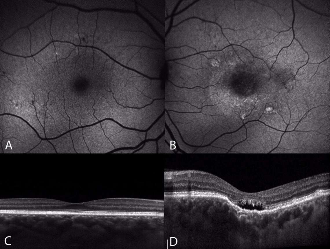 Figure 3. Clichés en autofluorescence (A, B) et OCT en mode EDI (C, D) d’une patiente de 55 ans avec une excavation choroïdienne focale fovéolaire au niveau de l’œil gauche. Au niveau de l’œil droit, la patiente présente une pachychoroïde à plus de 500 microns en fovéolaire associée à quelques AEP infracliniques visibles sur le cliché en autofluorescence. Au niveau de l’œil gauche, le cliché en autofluorescence met en évidence une hyper-autofluorescence centrale qui évoque un DSR chronique. Sur l’OCT EDI on note une excavation choroïdienne focale centrale non conforme, avec interposition d’un espace hyporéflectif entre les photorécepteurs et l’EPR (D).&nbsp;
