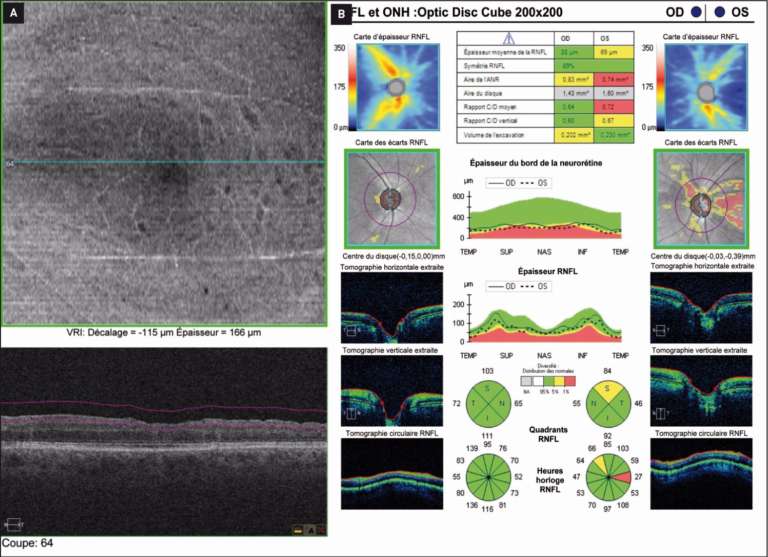 Figure 3. A. OCT en face à 12 mois postopératoire qui retrouve quelques DONFL. On note également une asymétrie d’épaisseur entre la neurorétine en nasal et en temporal sur l’OCT en coupe. B. OCT du même patient avec analyse RNFL montrant la perte en fibres localisée au secteur temporal de l’œil gauche opéré.
