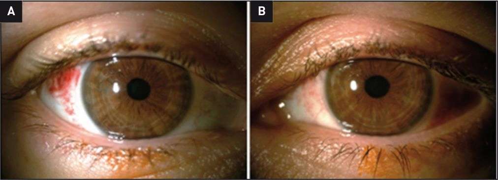 Figure 1. Photographie de l’œil droit (A) et de l’œil gauche (B) à J1 post-Lasik.
