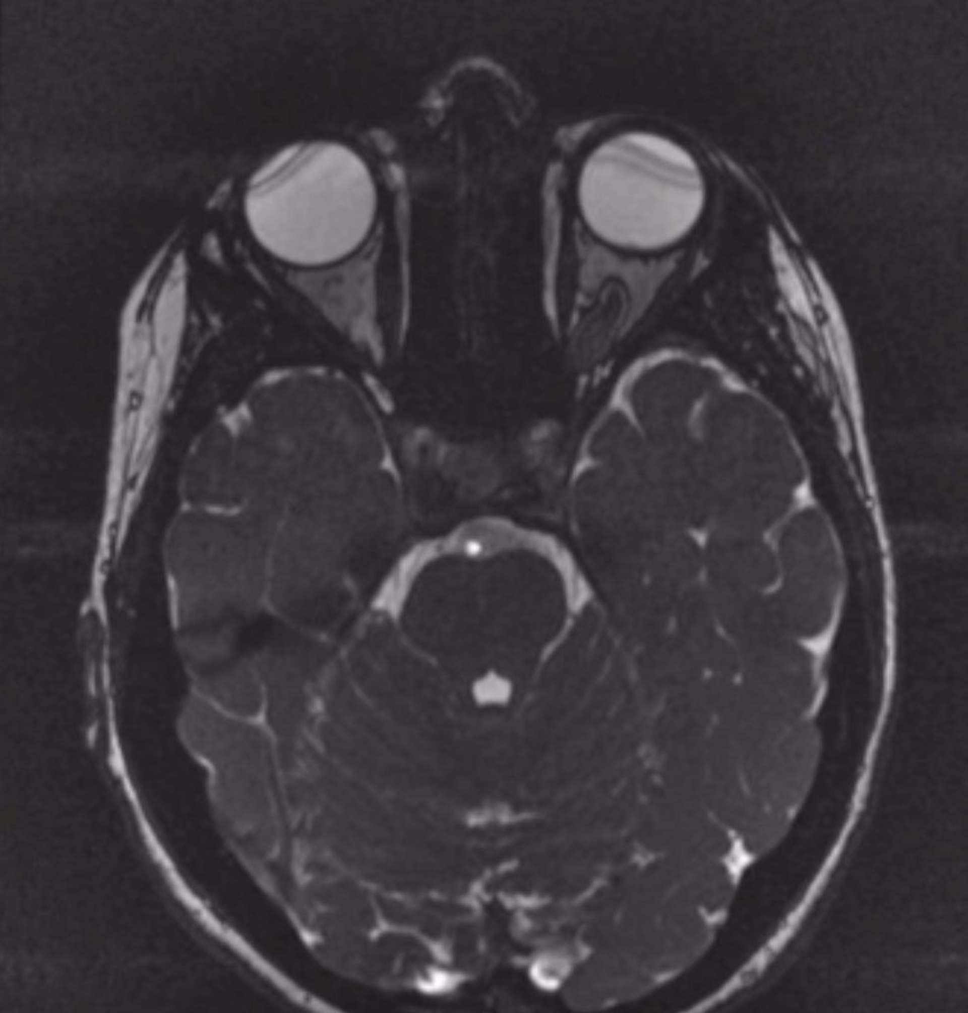 IRM cérébrale, découverte d’un gliome du nerf optique gauche dans le cadre du bilan d’une pâleur papillaire gauche (série personnelle).

