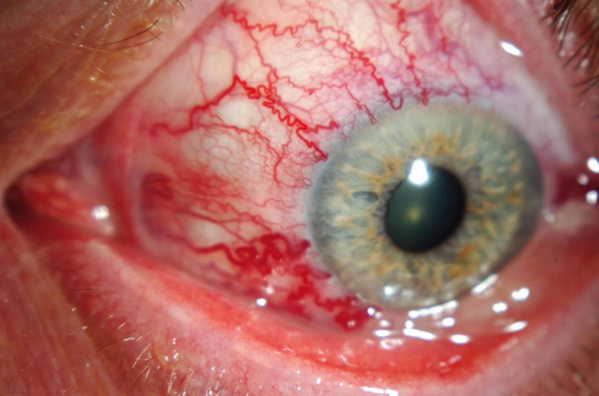 Photographie du segment antérieur de l’œil gauche : dilatation des vaisseaux épiscléraux et conjonctivaux en tête de méduse, chémosis inférieur, hyperhémie conjonctivale. Il n’existe pas d’exophtalmie.
