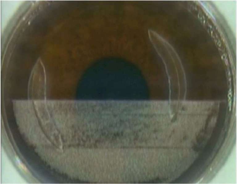 Photo en cours de réalisation du capot par le laser femtoseconde lors de la première phase de la technique de DIAKIK dans un cas d’astigmatisme congénital
