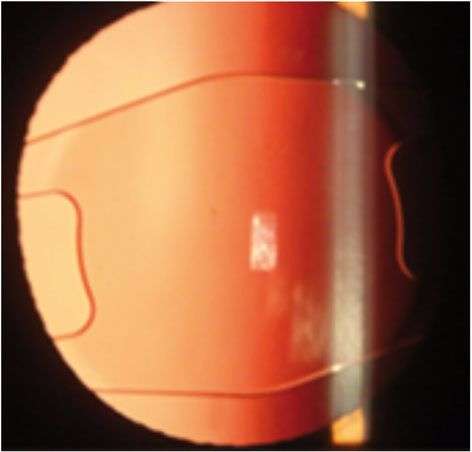 Figure 3. Implant phake.
