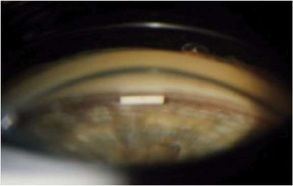 Implant de bimatoprost intracamérulaire situé dans l’angle iridocornéen 2 semaines après l’injection.&nbsp;
