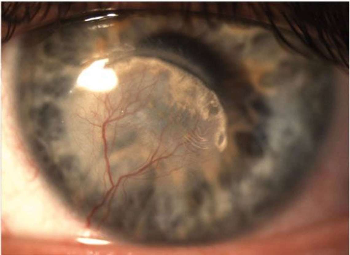 Dysfonctionnement des glandes de Meibomius et inflammation