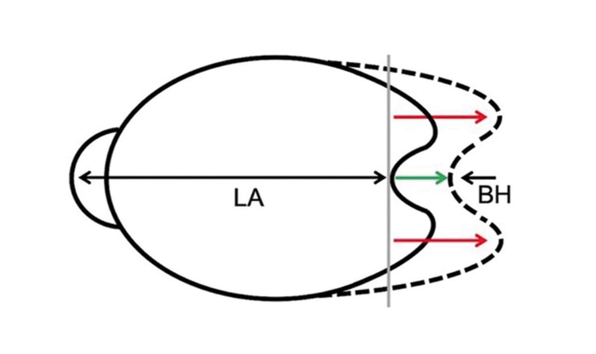 Figure 2. Allongement différentiel d’un œil présentant une macula bombée. L’évolution de la MB est présentée en pointillés : l’évolution de la longueur axiale (LA) (flèche verte) est plus importante que l’augmentation du bombement maculaire central, ou « bulge height » (BH) (flèche noire pointant vers la gauche) mais l’allongement périmaculaire (flèches rouges) est plus important que le changement de longueur axiale. L’allongement de l’œil est donc plus prononcé autour du bombement qu’à son sommet. Il existe un creusement de la région périmaculaire.
