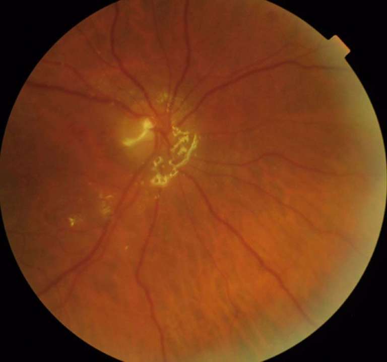Figure 1. Aspect postopératoire du fond d’œil d’un patient sous MCT similaire à un tamponnement interne par huile de silicone.
