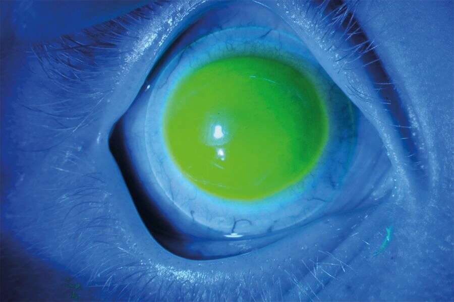 Figure 3. Photo en lumière bleue de l'œil droit&nbsp;adapté&nbsp;en lentilles sclérales : bon centrage, pas d’appui central, bon appui scléral.
