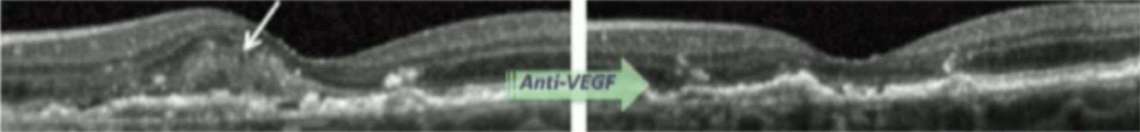 Figure 5. Disparition caractéristique du gris exsudatif après IVT d’anti-VEFG.

