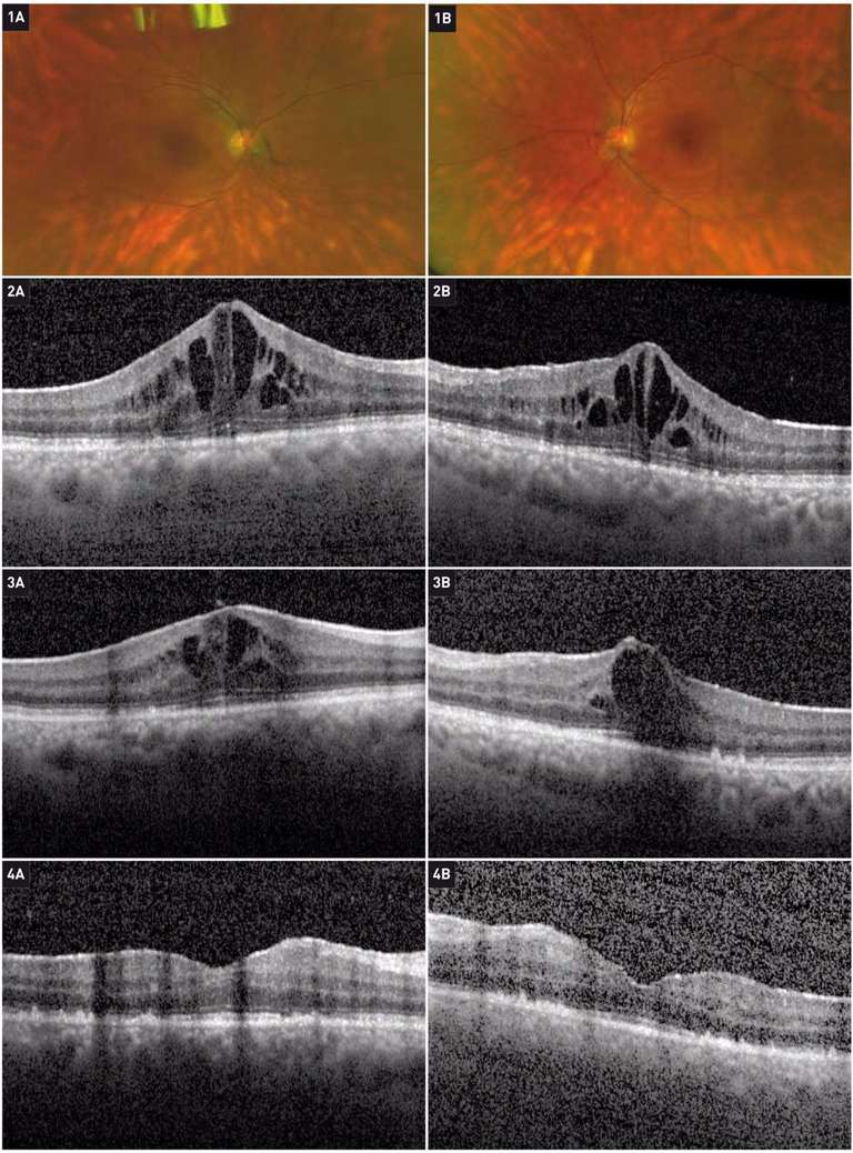 Figure 1. Un photographe de 56 ans se plaint de myodésopsies depuis un an et d’une baisse visuelle à 2/10 aux 2 yeux. Il souffre d’une uvéite postérieure avec une hyalite modérée, des granulomes choroïdiens et un œdème maculaire bilatéral sévère. Le diagnostic de rétinochoroïdopathie de type Birdshot associée à HLA A29 est confirmé. L’œdème maculaire est traité par 3 perfusions de méthylprednisolone (500 mg) puis relais par corticoïdes oraux à fortes doses associés à un traitement immunosuppresseur à visée d’épargne cortisonique. Rétinophotographies en couleurs de l’œil droit (1A) et gauche (1B). Évolution de son œdème maculaire sur les OCT : (2A et B) avant perfusion ; (3A et B) après 3 jours de perfusion de méthylprednisolone ; (4A et B) un mois après le traitement.
