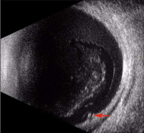 &nbsp;Figure 2. Échographie en mode B mettant en évidence une déchirure rétinienne (flèche rouge) et une hémorragie intravitréenne dense.
