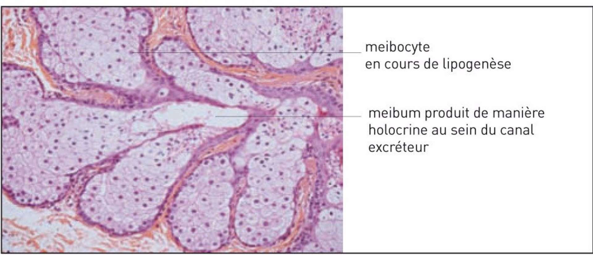 Figure 1. Coupe histologique après coloration HES grossissement x 20 montrant les glandes de Meibomius composées de meibocytes regroupés en acini (Léger F, Morice C). 
