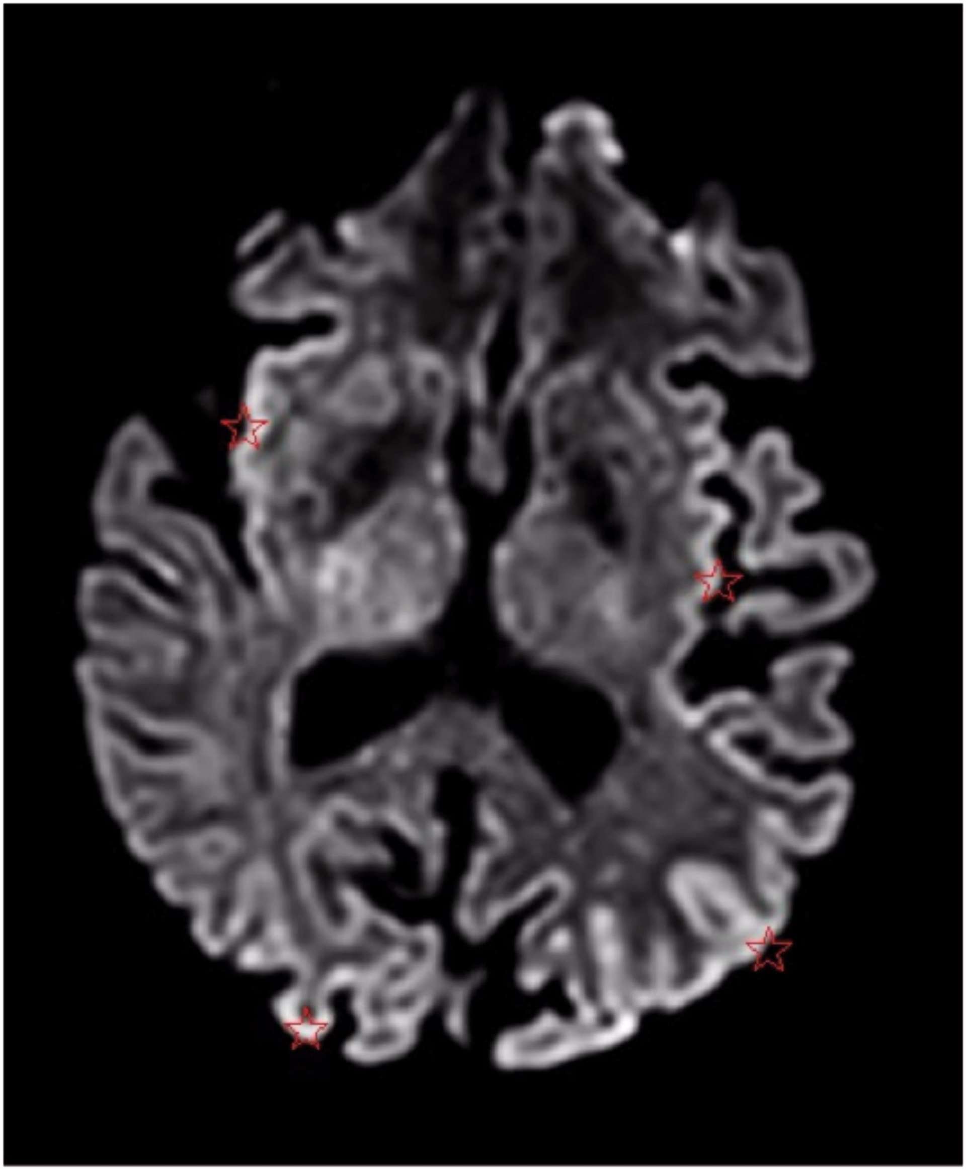 Figure 3. Séquences IRM en diffusion : hypersignal en diffusion relatif du cortex occipito-temporal, évocateur d’une maladie de Creutzfeldt-Jakob.
