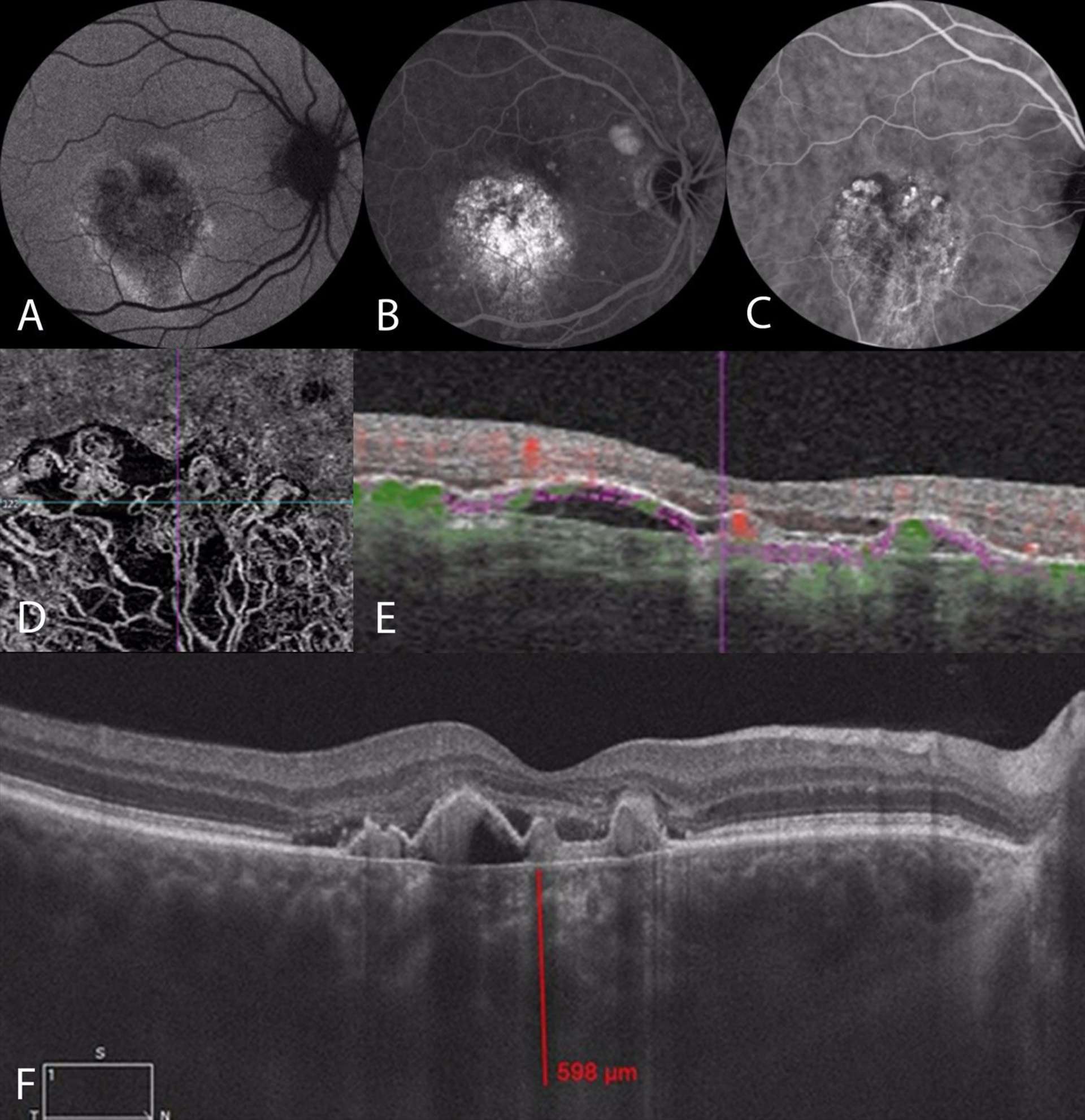 Figure 2. Imagerie multimodale d’un patient de 55 ans présentant une baisse d’acuité visuelle de l’œil droit liée à une vasculopathie polypoïdale associée à une pachychoroïde. Sur le cliché en autofluorescence (A), on note une ébauche de coulée gravitationnelle inféromaculaire. Sur l’angiographie à la fluorescéine au temps tardif (B), il y a une hyperfluorescence hétérogène maculaire avec des pin points. L’angiographie au vert d’indocyanine (C) met en évidence au temps précoce des dilatations polypoïdales en bordure d’un lacis néovasculaire de type 1. Le lacis néovasculaire est bien visible sur l’OCT-A (D), segmenté au niveau de la choriocapillaire (E). La coupe fovéolaire horizontale d’OCT en mode EDI met en évidence des dilatations ogivales entre la membrane de Bruch et l’EPR typiques de polypes, associées à une pachychoroïde mesurée à près de 600 microns au centre de la fovea et à un DSR central. 
