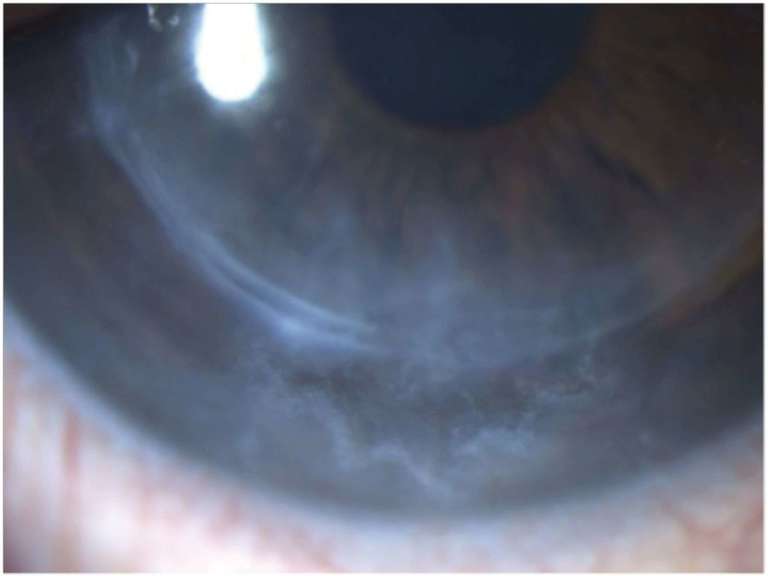 Figure 2A.&nbsp;Photographie de l’œil gauche à 8 jours de la prise en charge.
