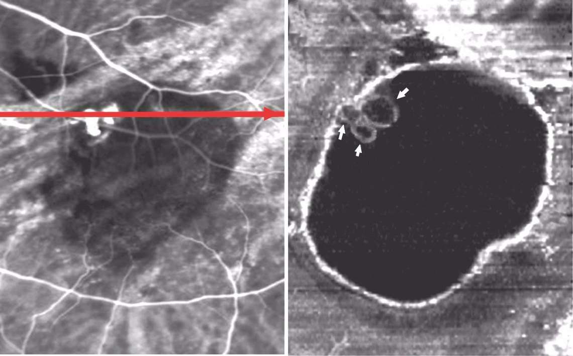 Angiographie ICG (à gauche) et OCT en face (à droite) d’une vasculopathie polypoïdale mettant en évidence trois polypes en amas bien distincts (flèches blanches).
