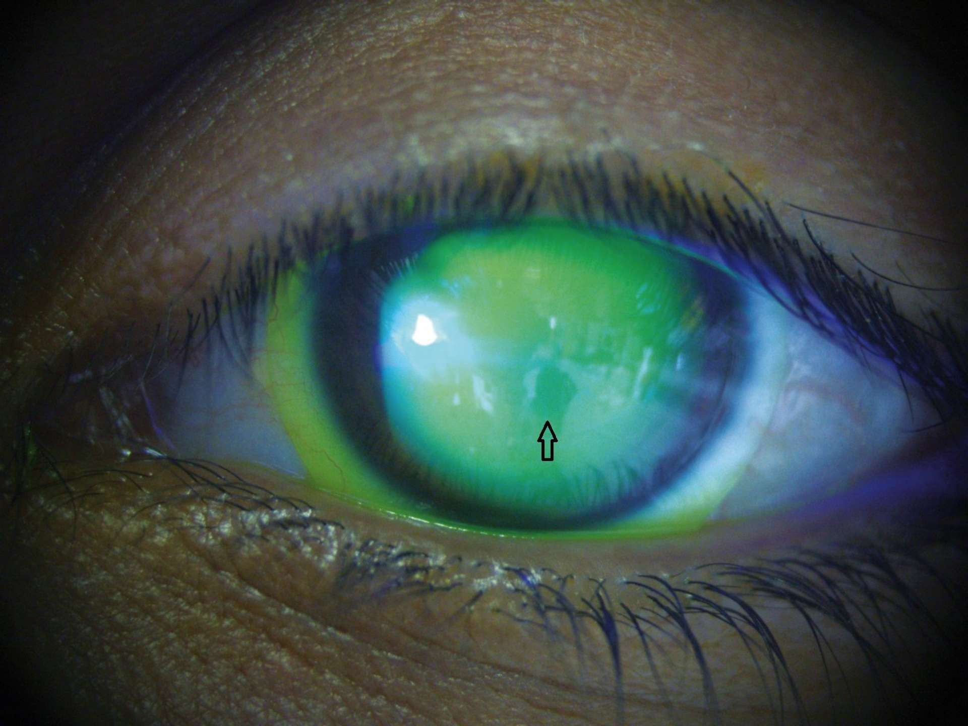 Figure 2. Analyse en ­ lumière bleue fente large du rayon de la ­lentille ­cornéo­sclérale Rose K2 XL de l’œil gauche. Il existe un léger « affleurement » de la lentille au niveau du cône, donnant une image légèrement fluorescéine négative (↑).
