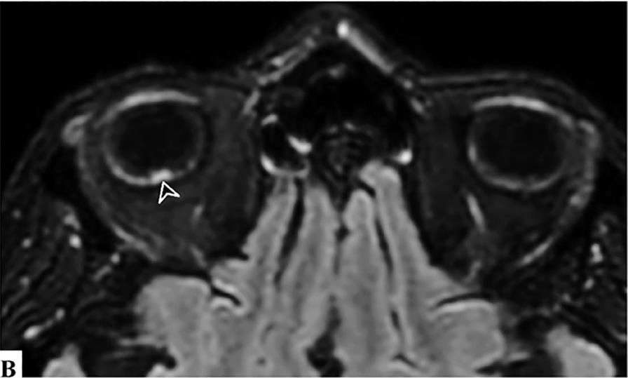 Cette IRM (séquence FLAIR) a été obtenue chez un patient de 56 ans atteint d’une forme sévère de la Covid-19 et hospitalisé alors depuis 20 jours au service de soins intensifs. L’imagerie révèle plusieurs nodules hyperintenses sur le pôle postérieur du globe oculaire localisé dans la région maculaire (têtes de flèches blanches) et dans la région extramaculaire (têtes de flèches noires). Un décollement rétinien focal et temporal est également observable (flèche blanche).
