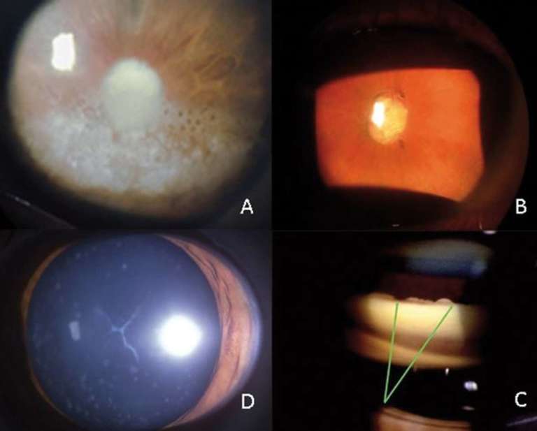 Figure 2. Complications antérieures de l’uvéite liée à l’arthropathie juvénile idiopathique : kératopathie en bandelette (A), séclusion pupillaire (B), synéchies (flèches vertes) dans l’angle iridocornéen responsables d’un glaucome uvéitique (C), cataracte uvéitique (D).
