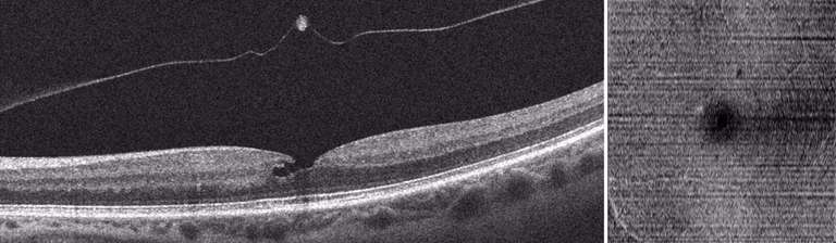 Figure 3. Coupe d’OCT B-scan et OCT En-face d’un trou maculaire lamellaire (« lamellar maculaire hole ») : il existe une perte de substance fovéolaire survenue suite au décollement postérieur du vitré, les contours fovéolaires sont irréguliers.
