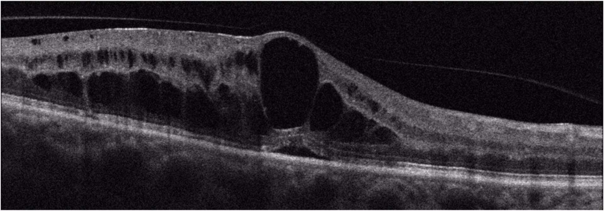 Figure 1. A. Coupe B-scan d’un œdème maculaire diffus chez un patient diabétique ; on identifie des kystes intramaculaires associés à du liquide intrarétinien et à un léger décollement séreux rétinien. 
