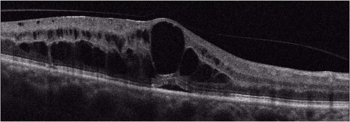 Figure 1. A. Coupe B-scan d’un œdème maculaire diffus chez un patient diabétique ; on identifie des kystes intramaculaires associés à du liquide intrarétinien et à un léger décollement séreux rétinien.&nbsp;
