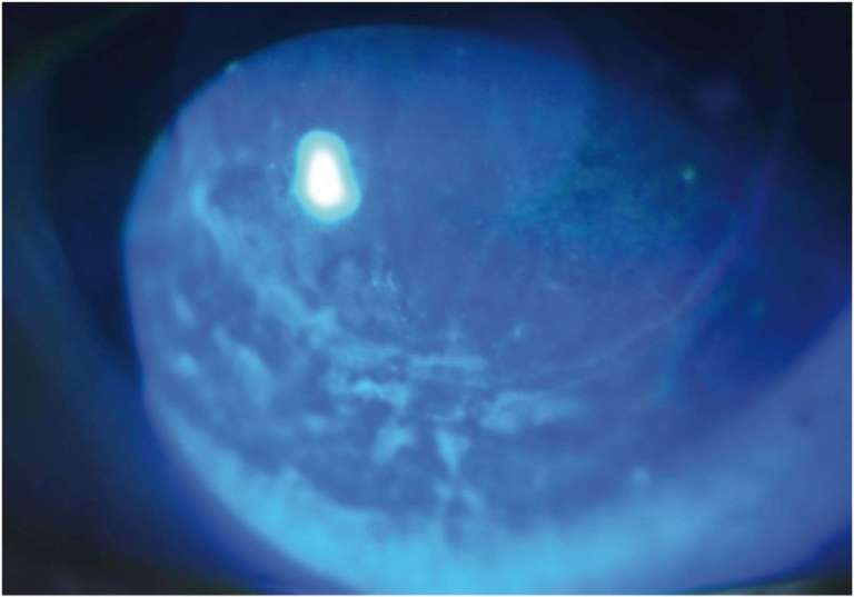 Figure 3B.&nbsp;Puis en lumière bleue après l’instillation d’une goutte de fluorescéine.
