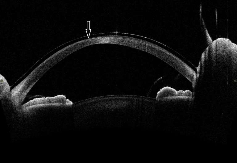 Figure 6. Image en OCT grand champ (Casia) de la lentille ­cornéo­sclérale Rose K2 XL avec une coupe verticale 293°/113° passant par l’apex du cône et montrant un rétrécissement de l’espace ­liquidien en regard de l’apex (↓).
