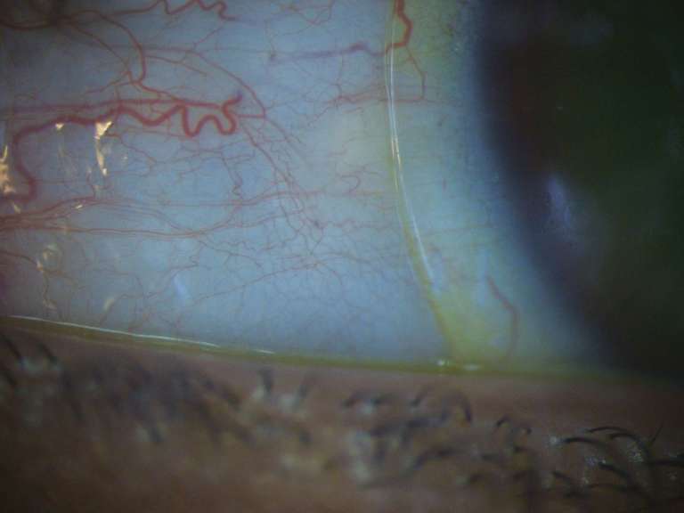 Figure 4. Analyse en lumière blanche fente large et fort ­grossissement de la zone d’appui de la lentille sur la sclère. La zone d’appui est bien alignée à la sclère en nasal.

