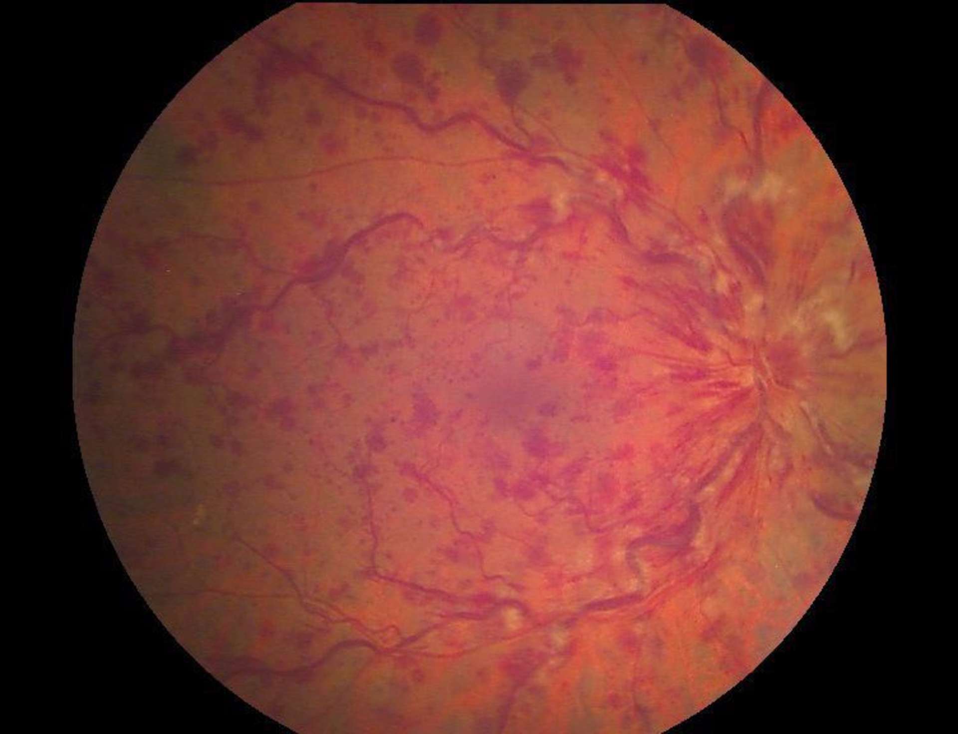 OVCR œdémateuse de l’œil droit à trois semaines. AV à 6/10, hémorragies rétiniennes diffuses, dilatation et tortuosité veineuses, nodules cotonneux (cliché couleur du FO).
