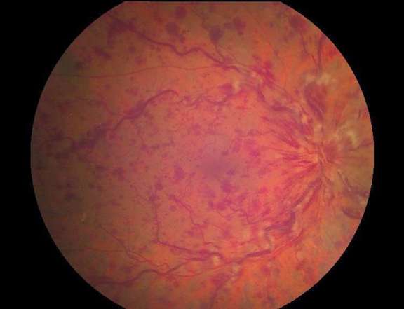 OVCR œdémateuse de l’œil droit à trois semaines. AV à 6/10, hémorragies rétiniennes diffuses, dilatation et tortuosité veineuses, nodules cotonneux (cliché couleur du FO).
