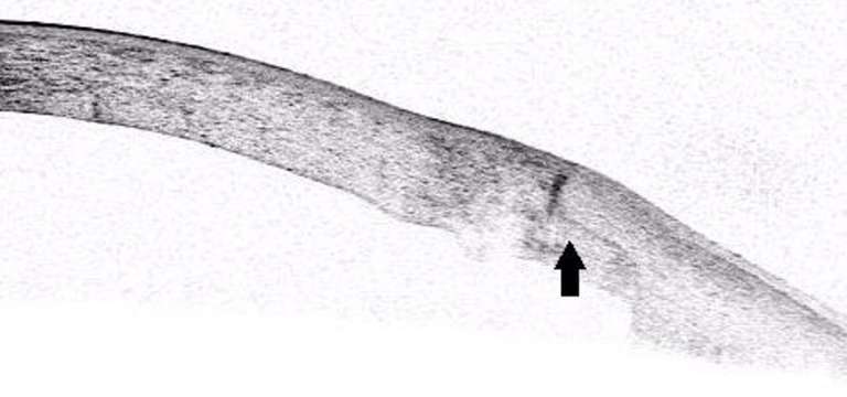 Image OCT d’une kératoplastie transfixiante réalisée avec découpe au laser femtoseconde en profil « Top Hat » (flèche noire). Cette image permet d’observer la congruence parfaite greffonreceveur, la surface de cicatrisation majorée par rapport à une découpe linéaire et la surface endothéliale greffée plus importante que la surface épithéliale
