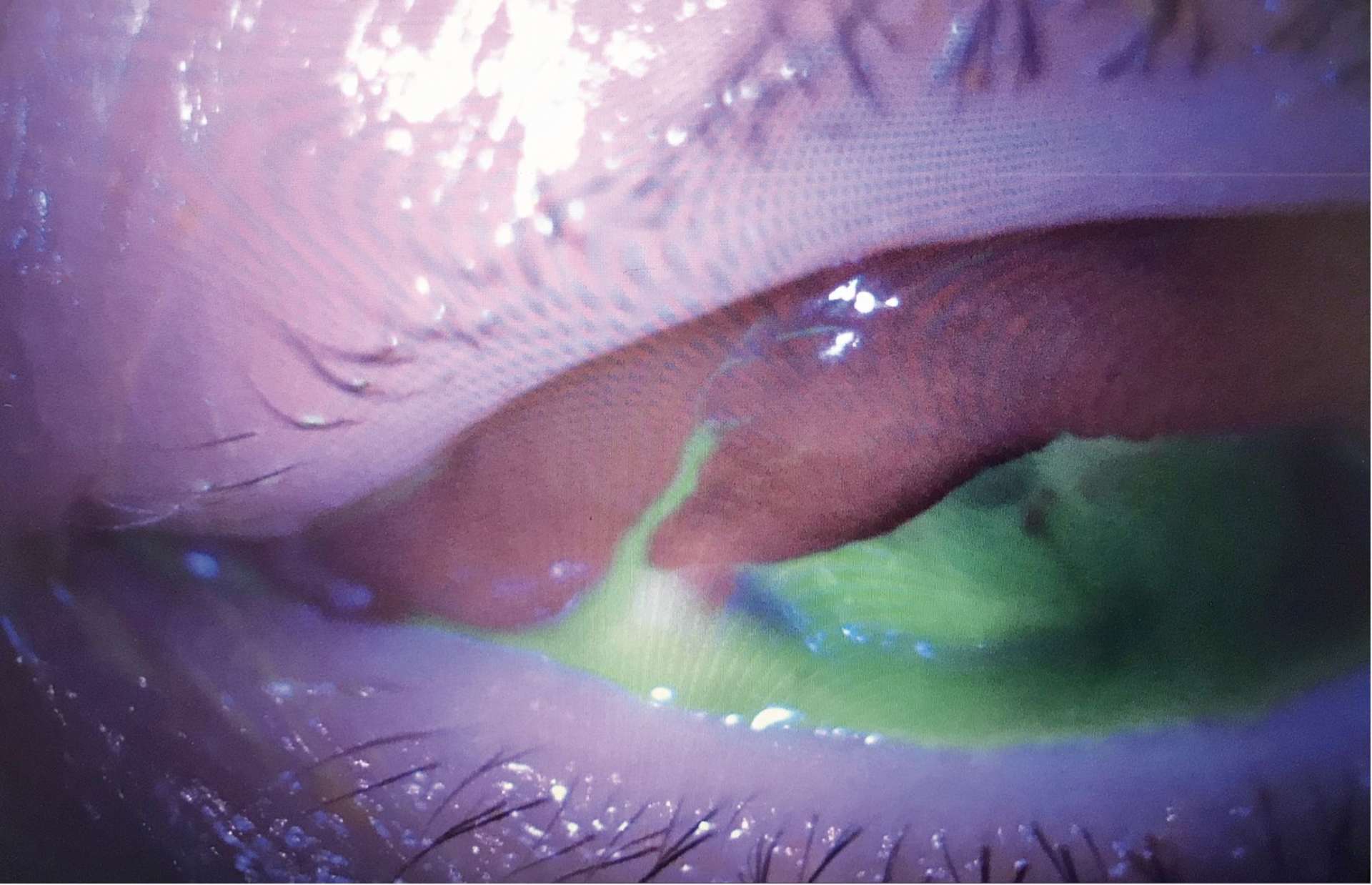 Figure 2. Examen à la lampe à fente après instillation de fluoresceine œil gauche présentant un signe de Seidel conjonctival : forte suspicion de plaie pénétrante du globe oculaire.

